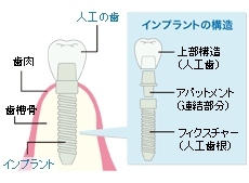 インプラントの仕組み：イラスト