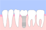 インプラント治療例