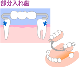 部分入れ歯治療例