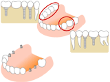 インプラント治療例