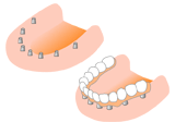 インプラント治療例