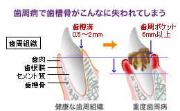 歯周病はインプラント治療の妨げになります