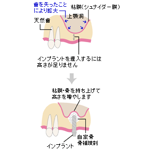 サイナスリフト