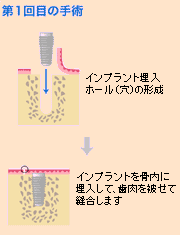 1次手術：インプラントの埋入