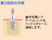 2次手術：インプラント上部構造のセット