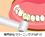 専門的なクリーニング（PMTC）