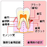 歯周病のイメージ