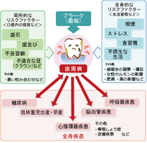 歯周病がもたらす影響