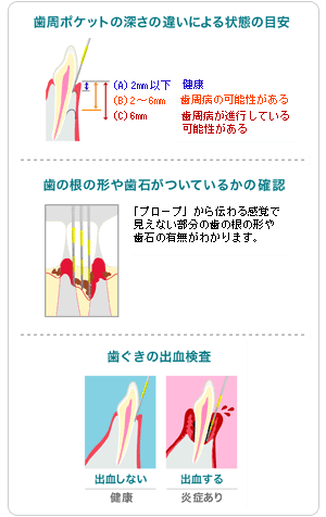 歯周ポケット検査