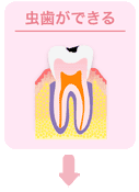 虫歯ができる