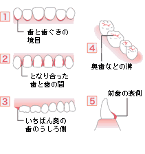 図：プラークのたまりやすい場所